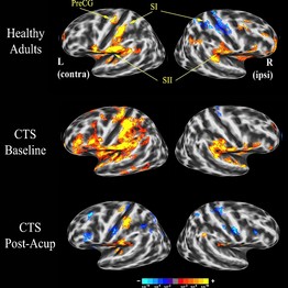 Click to enlarge. The effects of acupuncture on the brain.