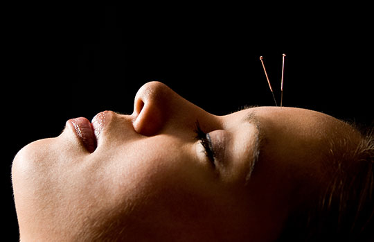 acupuncture-treatment