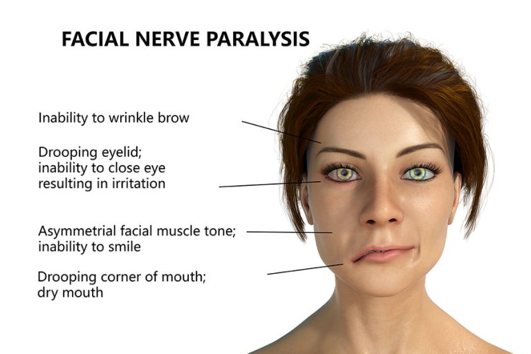 Bell's Palsy Natural Treatment Overland Park Acupuncturist