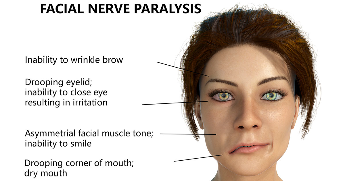 Bell's Palsy Natural Treatment Overland Park Acupuncturist