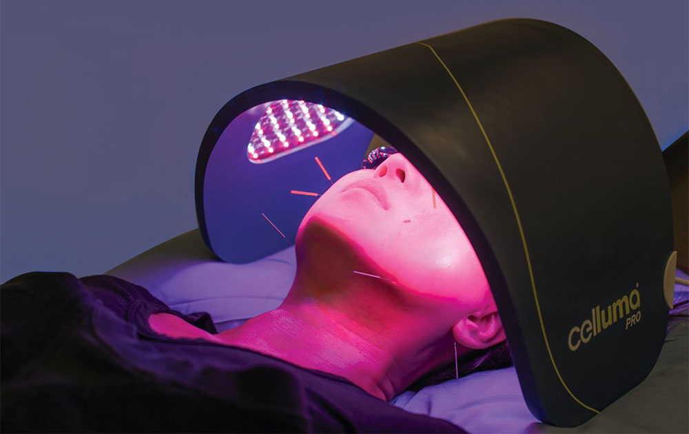 Woman getting red light therapy and acupuncture treatment on face in Overland Park, KS.