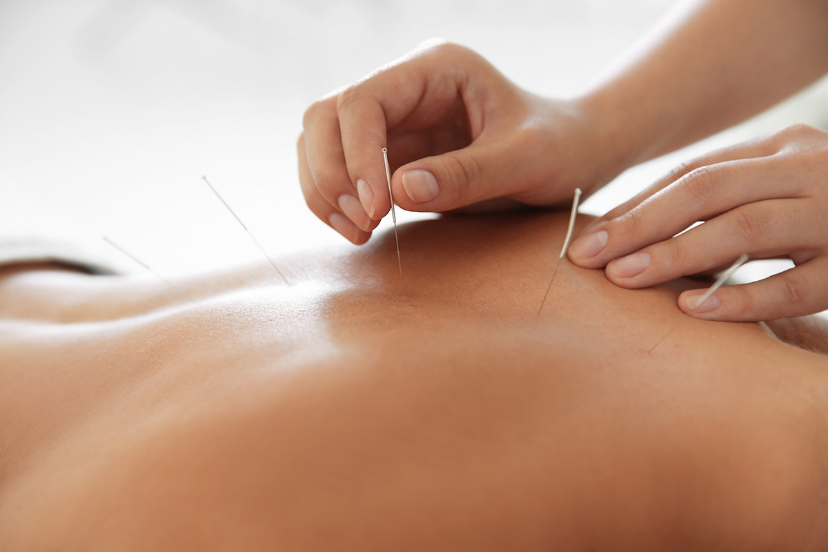Young woman undergoing acupuncture treatment for back pain.