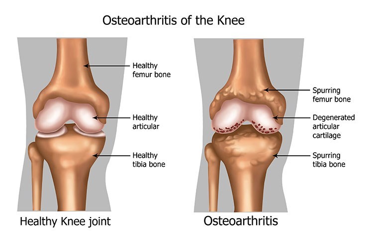 Osteoarthritis Pain Relief In Overland Park, KS - Overland Park  Acupuncture Clinic