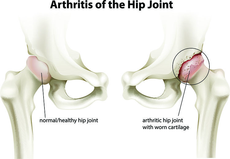 Arthritis Pain Relief In Overland Park, KS - Overland Park  Acupuncture Clinic