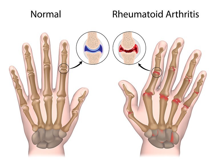 Rheumatoid Arthritis Pain Relief In Overland Park, KS - Overland Park  Acupuncture Clinic