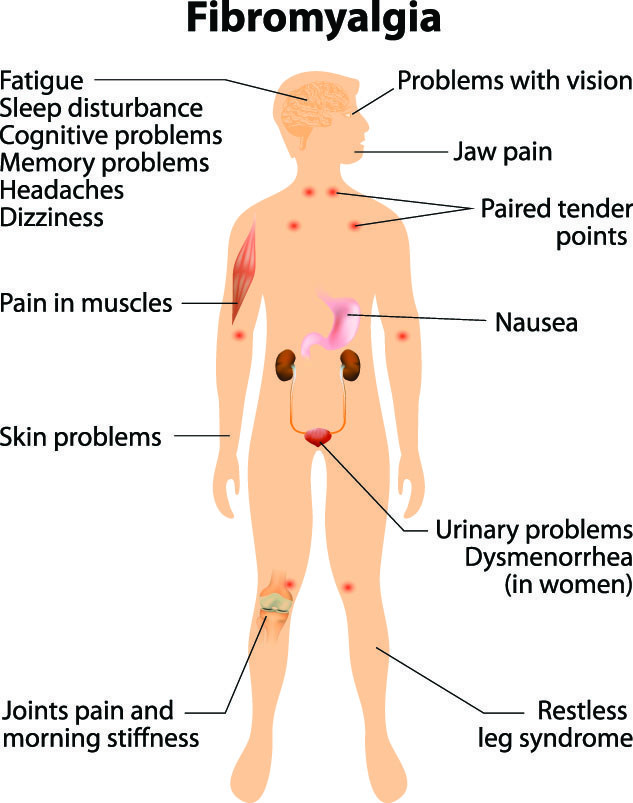 Fibromyalgia Natural Treatment With Chinese Medicine - Overland Park  Acupuncture Clinic